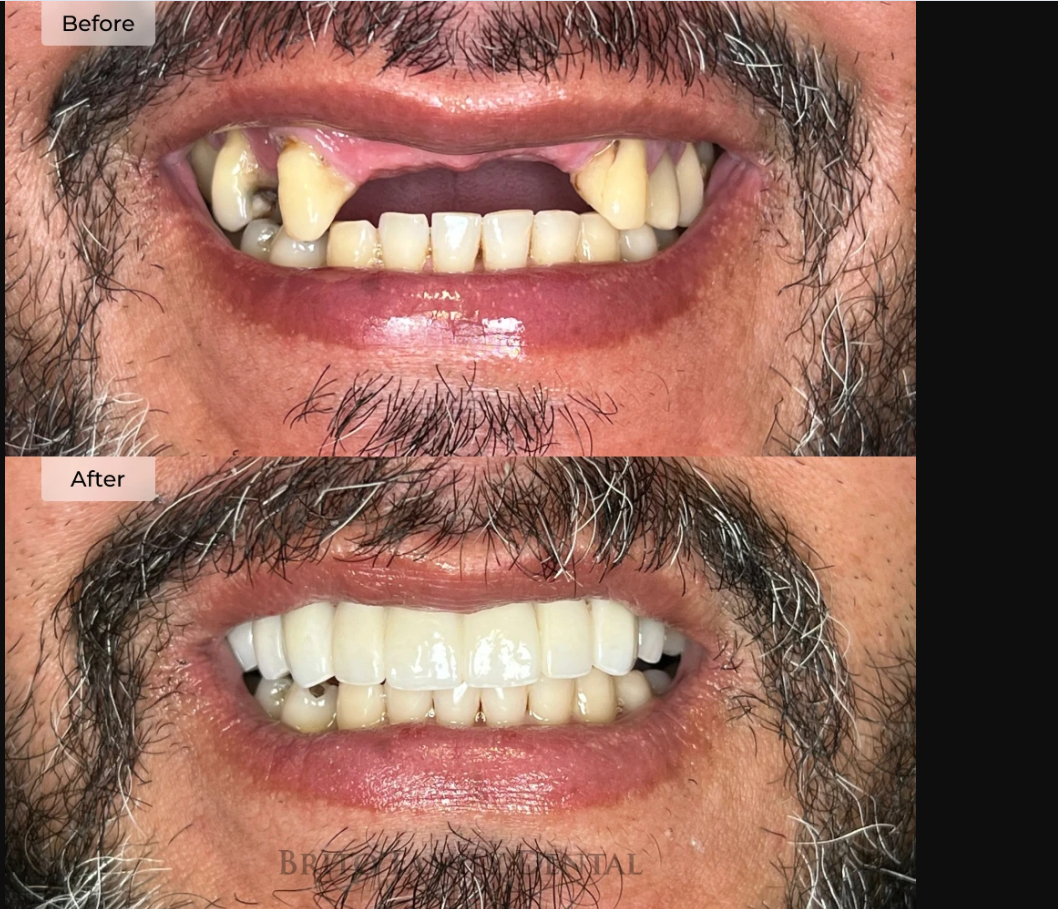 Seera Family Dental implant restoration result 2