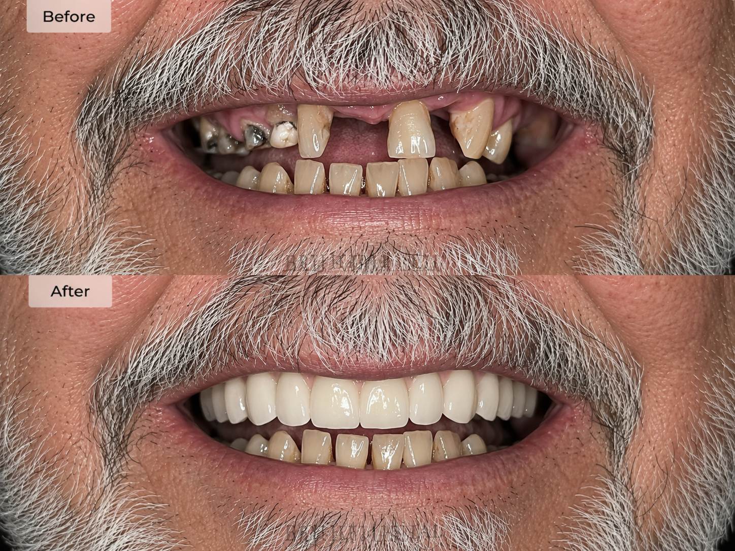 Seera Family Dental implant restoration result 3