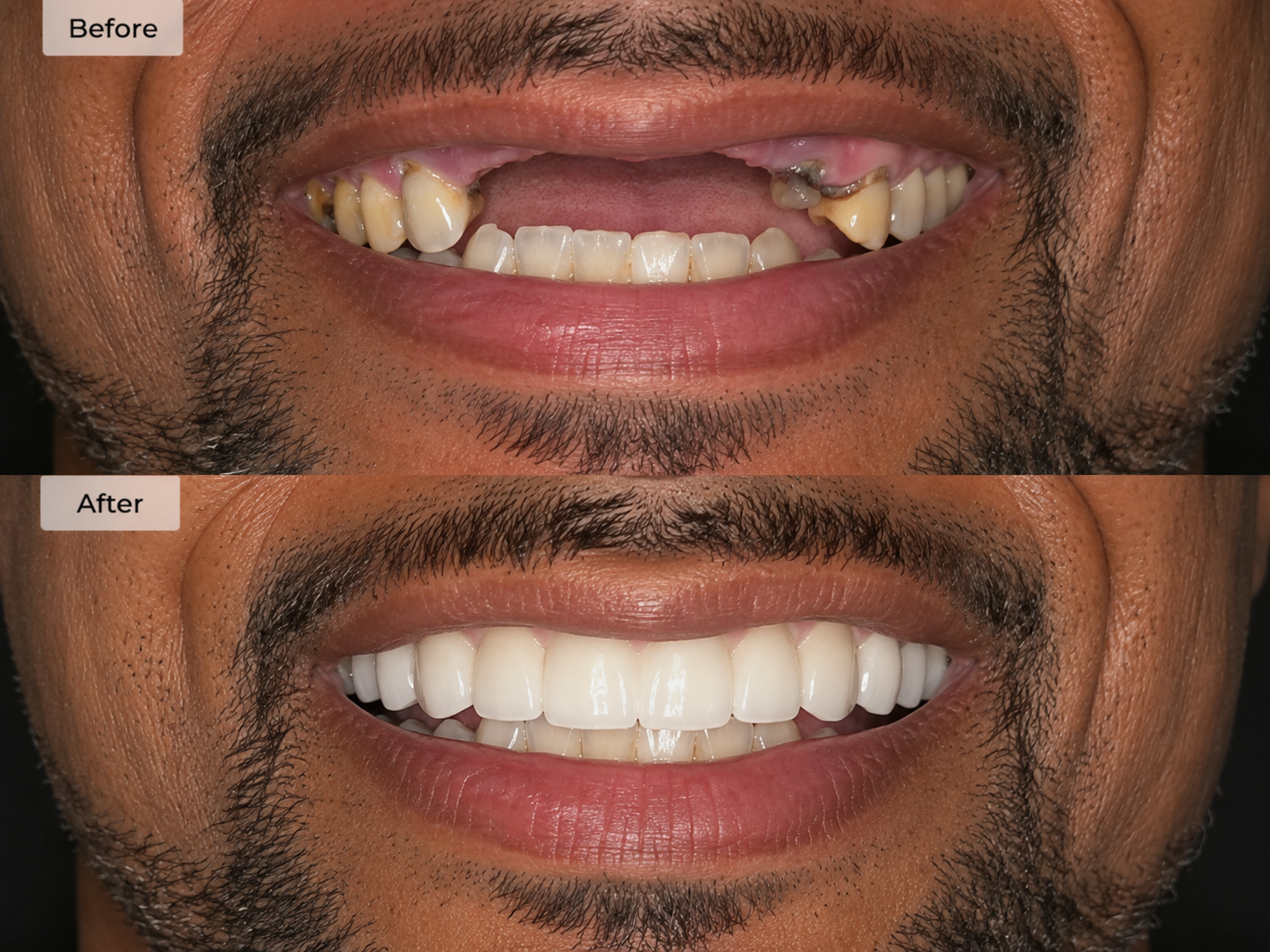 All-on-X — 6 Implants — Dr. Seera patient result