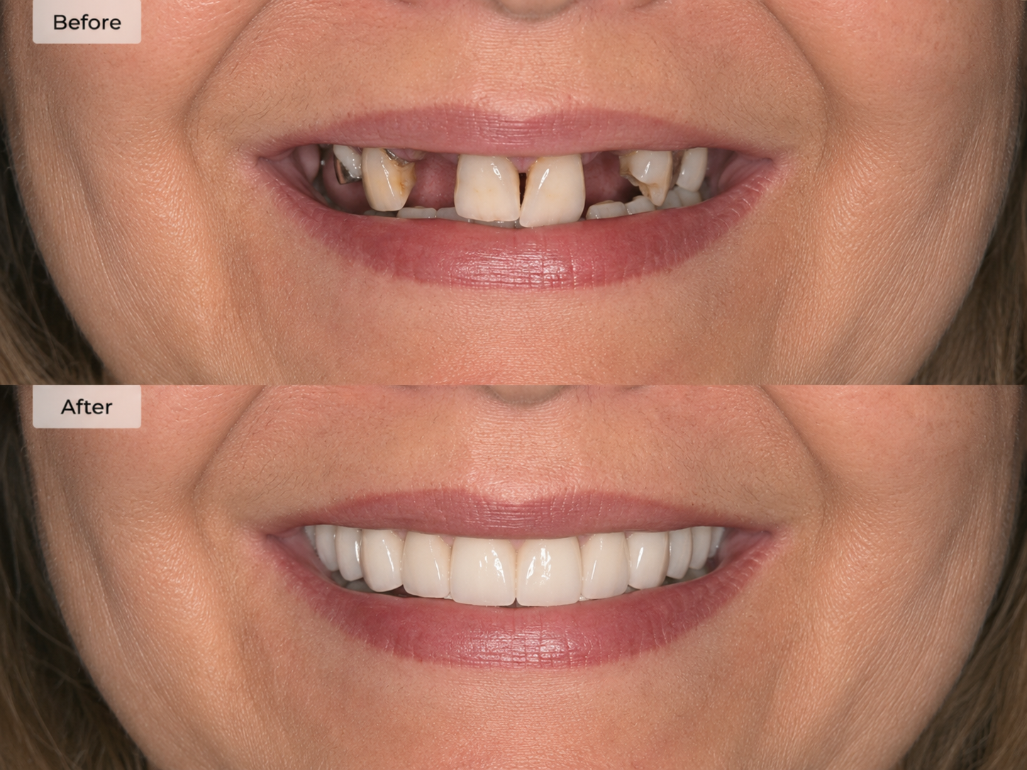 Female Arch Restoration — Dr. Seera patient result