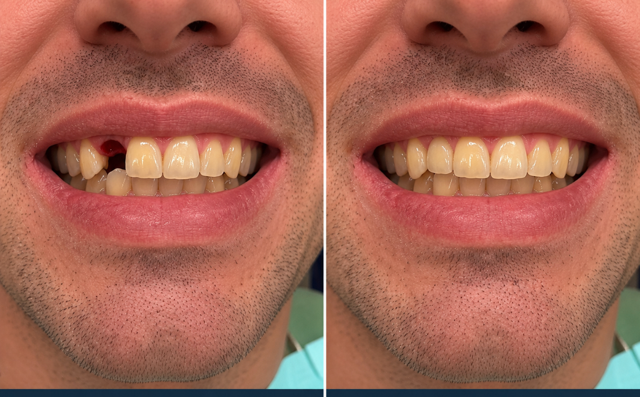 Single Tooth Implant — Dr. Seera patient result