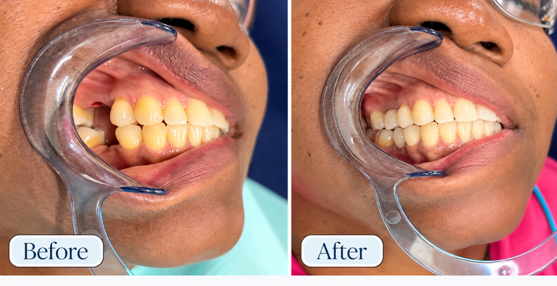 Implant Restoration — Dr. Seera patient result