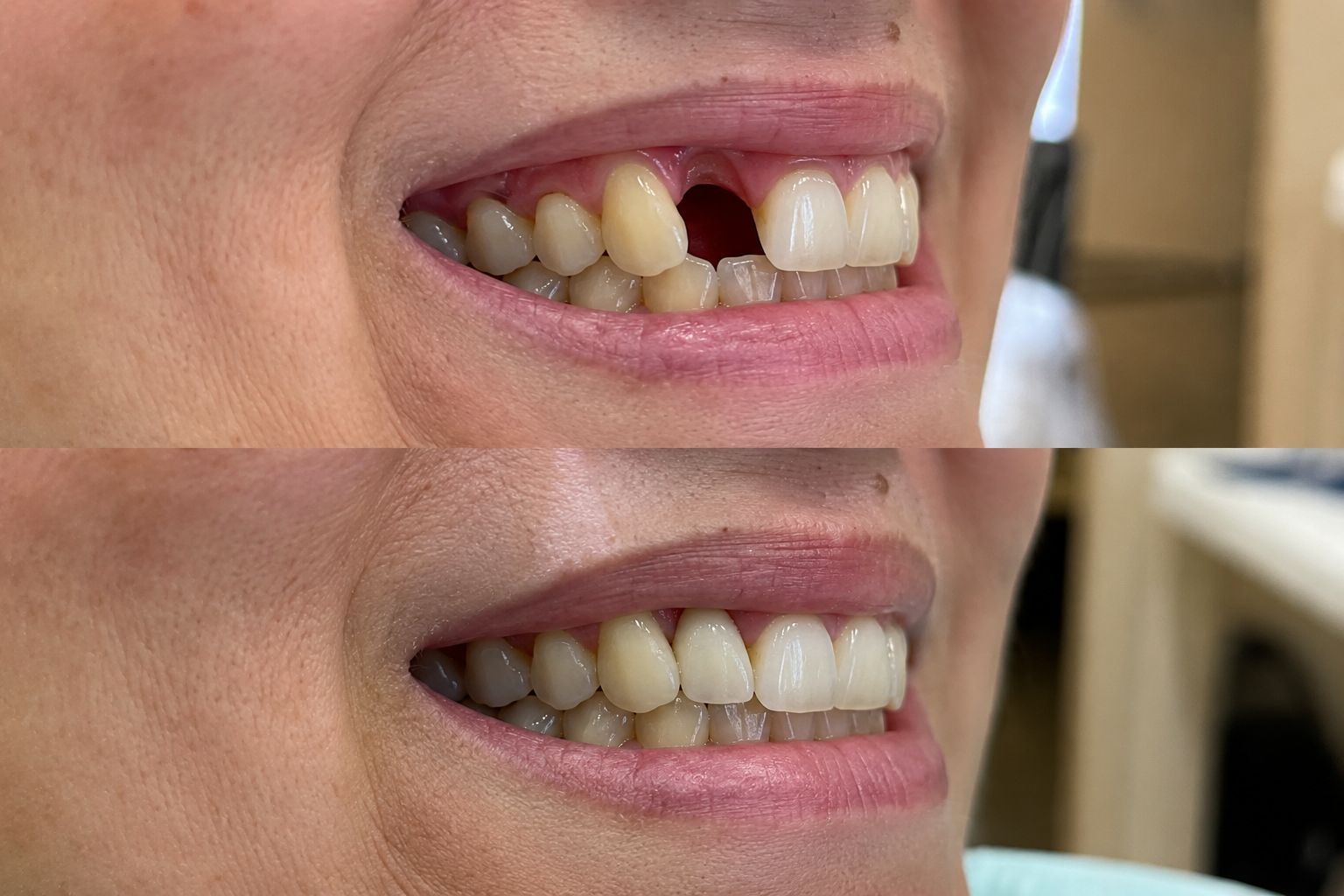 Dental implant before and after result